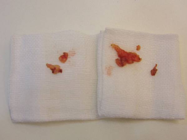 星采大安_眼袋淚溝填平_邱大睿院長10 星采大安_眼袋淚溝填平_邱大睿院長10