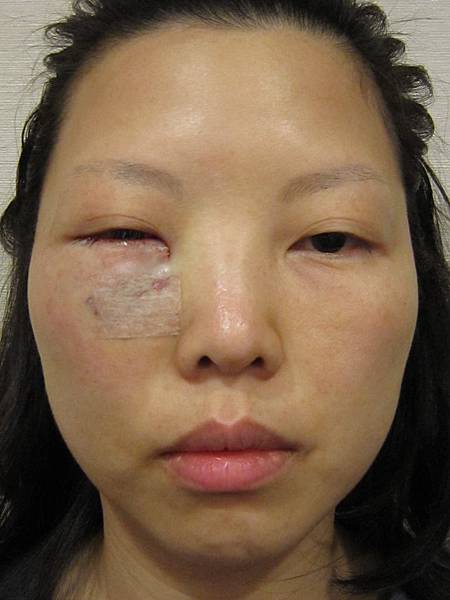 星采大安_眼袋淚溝填平_邱大睿院長08 星采大安_眼袋淚溝填平_邱大睿院長08