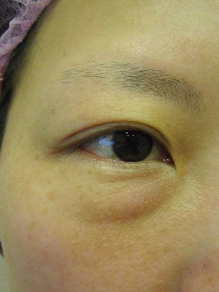 星采大安_眼袋淚溝填平_邱大睿院長07 星采大安_眼袋淚溝填平_邱大睿院長07