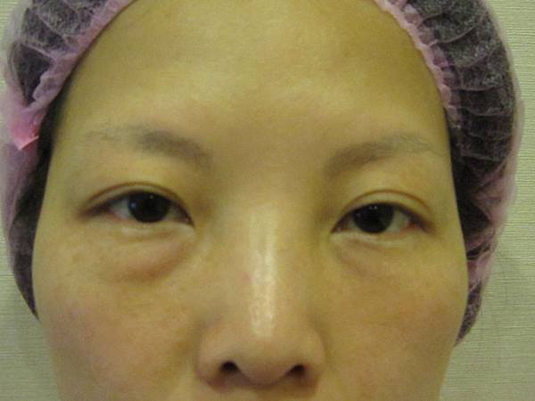 星采大安_眼袋淚溝填平_邱大睿院長06 星采大安_眼袋淚溝填平_邱大睿院長06