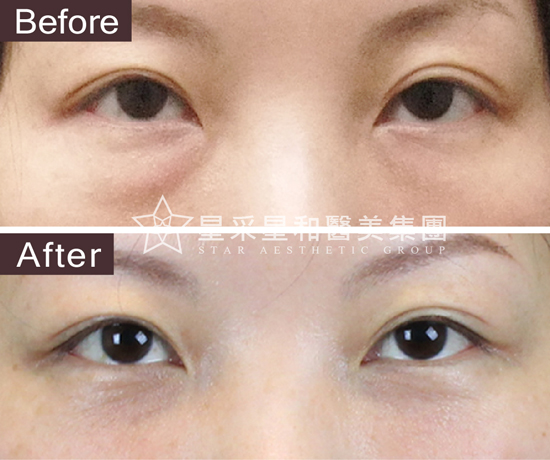 星采大安_眼袋淚溝填平_邱大睿院長02 星采大安_眼袋淚溝填平_邱大睿院長02
