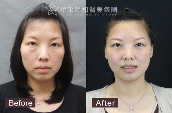 星采大安_眼袋淚溝填平_邱大睿院長01 星采大安_眼袋淚溝填平_邱大睿院長01