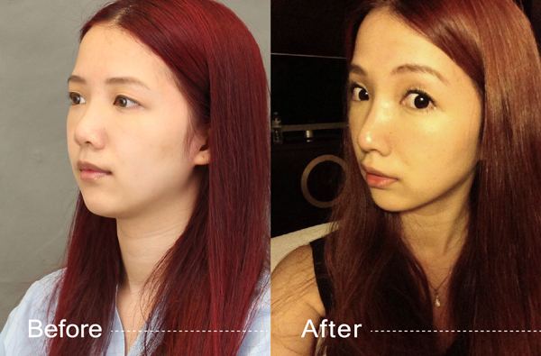 星采大安醫美_韓式隆鼻/三段式隆鼻_邱大睿院長16 星采大安醫美_韓式隆鼻/三段式隆鼻_邱大睿院長16