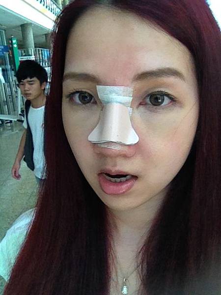 星采大安醫美_韓式隆鼻/三段式隆鼻_邱大睿院長10 星采大安醫美_韓式隆鼻/三段式隆鼻_邱大睿院長10