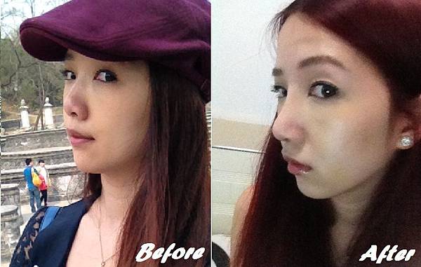 星采大安醫美_韓式隆鼻/三段式隆鼻_邱大睿院長03 星采大安醫美_韓式隆鼻/三段式隆鼻_邱大睿院長03