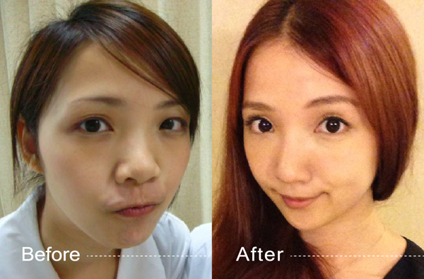 星采大安醫美_韓式隆鼻/三段式隆鼻_邱大睿院長01 星采大安醫美_韓式隆鼻/三段式隆鼻_邱大睿院長01