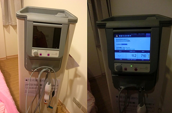 星和_電波拉皮＋晶亮瓷填補下巴_貴婦04