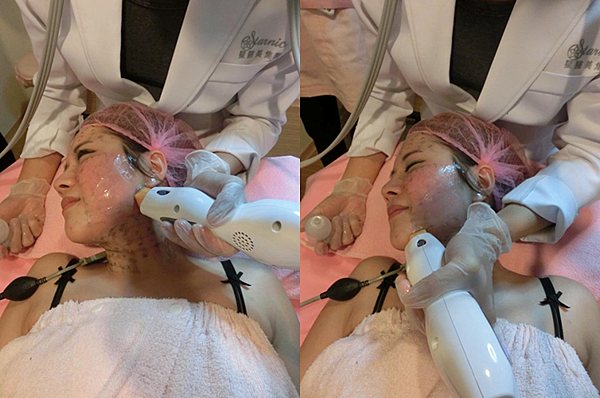 星和_電波拉皮＋晶亮瓷填補下巴_貴婦07