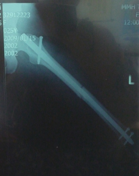 裝完鋼釘.JPG 裝完鋼釘.JPG