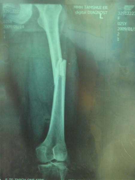 大腿股骨折 大腿股骨折