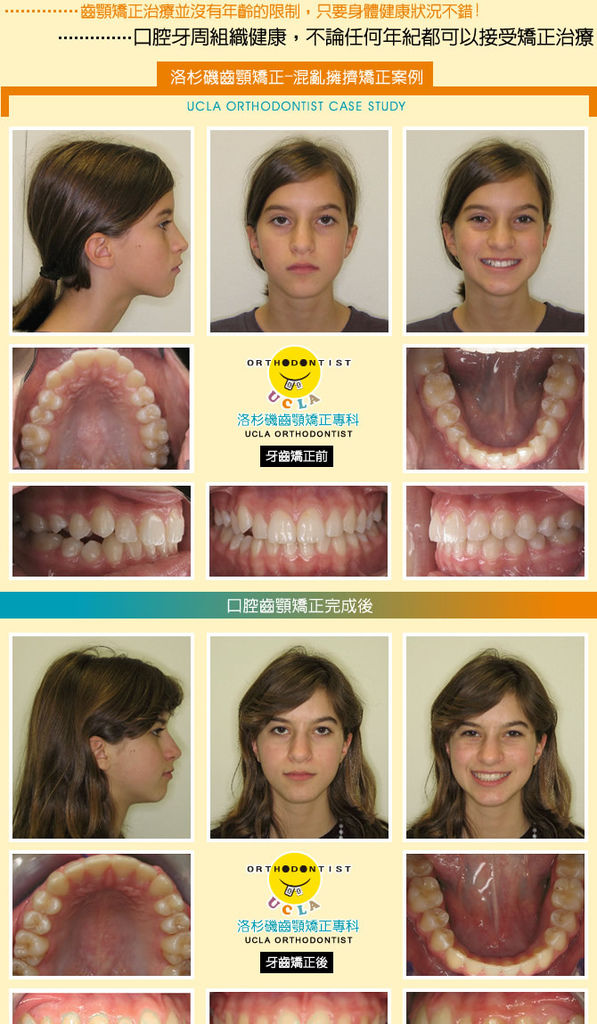 台北牙齒矯正混亂擁擠牙齒矯正案例分享一