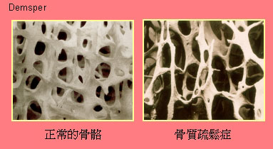 骨質疏鬆