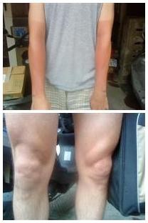 手腳曬傷集合 手腳曬傷集合