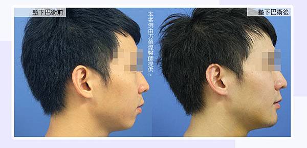 男墊下巴手術1