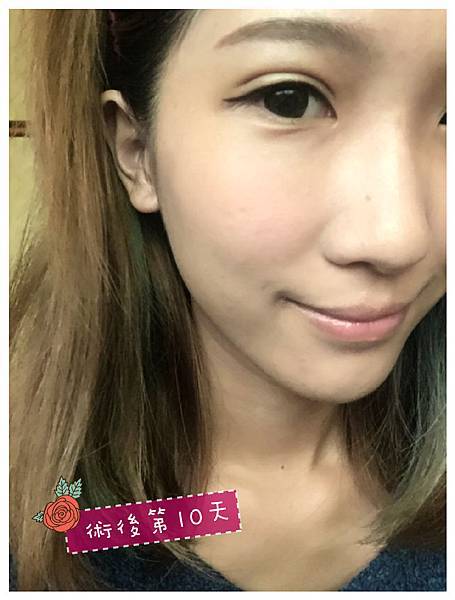 小十雙眼皮組圖-06 小十雙眼皮組圖-06