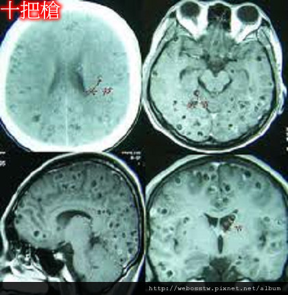 腦囊蟲病2