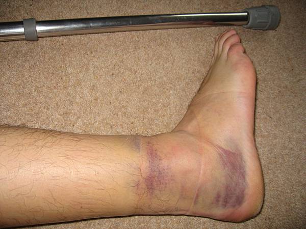 ankle sprain