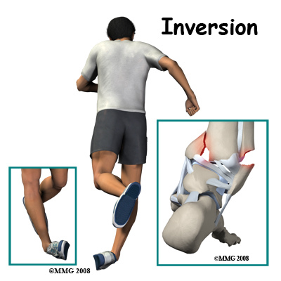 ankle sprain ankle sprain