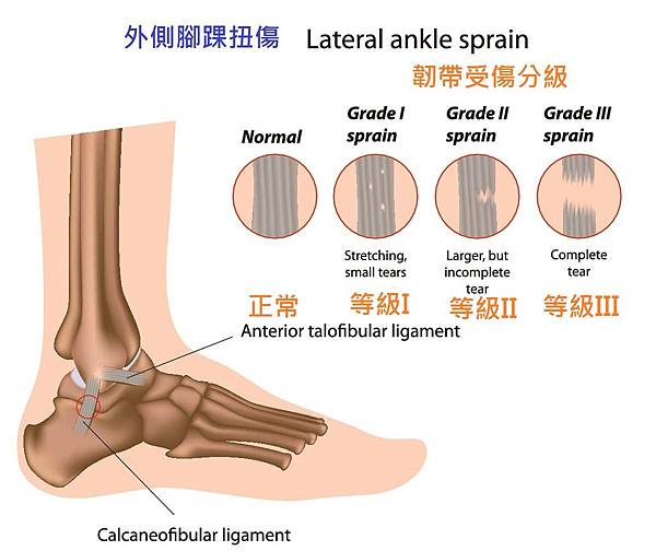 ankle sprain