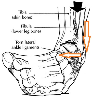 ankle sprain