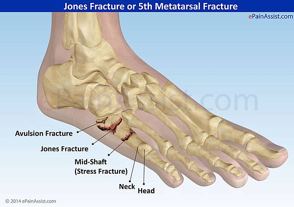 ankle sprain