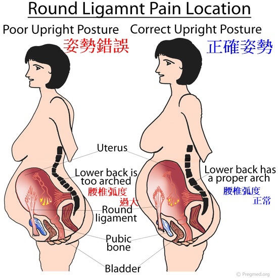 Round-Ligament-Pain-Location