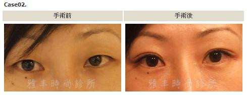 縫雙眼皮手術案例2.jpg 縫雙眼皮手術案例2.jpg