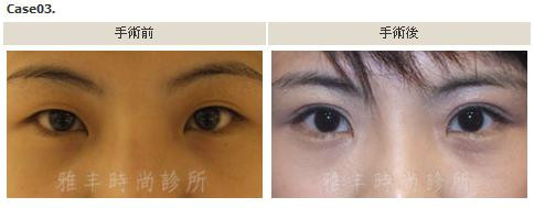 縫雙眼皮手術案例3.jpg 縫雙眼皮手術案例3.jpg