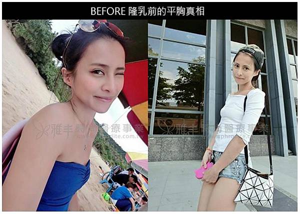 KiKi雅丰隆乳手術全心得02 KiKi雅丰隆乳手術全心得02