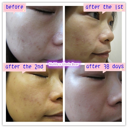 NuMe 15.jpg NuMe 15.jpg