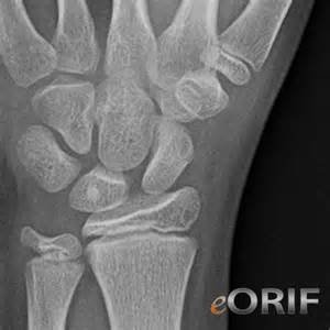 手舟狀骨骨折 中壢高正雄骨科復健診所 痞客邦 手舟狀骨骨折 中壢高正雄骨科復健診所 痞客邦