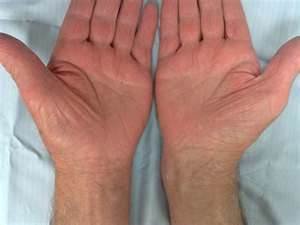 腕隧道症候群 中壢高正雄骨科復健診所 痞客邦