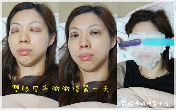 靓媽咪-縫雙眼皮002.jpg