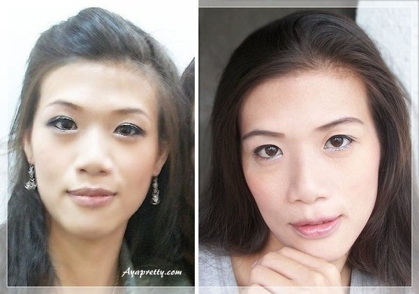 AYA三段式隆鼻-縫雙眼皮