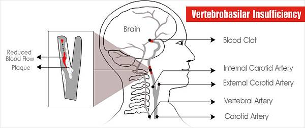 causes-of-beauty-parlor-stroke-syndrome-blood-clot.jpg