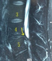 第四腰椎椎間盤軟骨壓迫神經.jpg