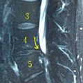 椎體內軟骨壓迫.jpg