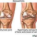 膝關節軟骨退化.jpg