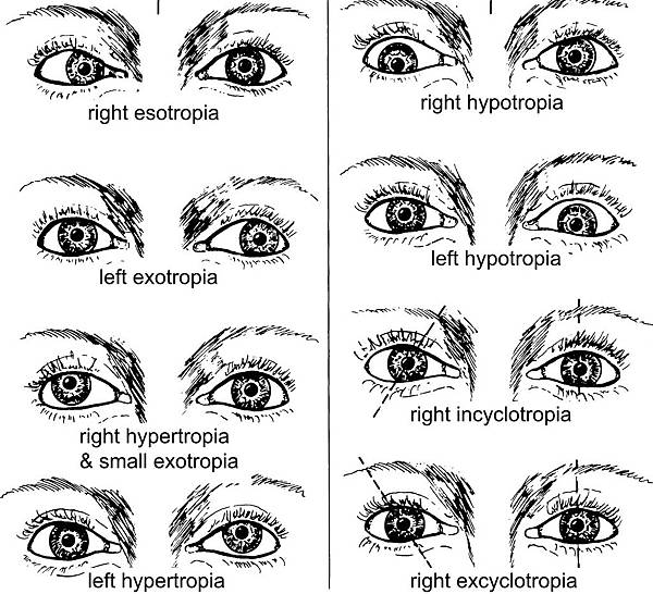 8-02 directions of tropia