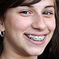 braces1.jpg