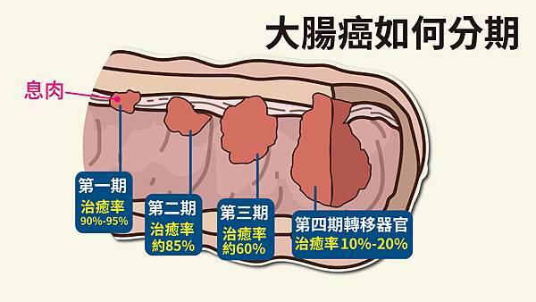 護腸四招遠離大腸癌大腸期數.jpg