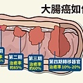 護腸四招遠離大腸癌大腸期數.jpg