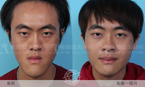 正顎手術 Omg 我想治好戽斗啦 我非得做正顎手術嗎 Acme Sculpture 極緻美人 痞客邦 正顎手術 Omg 我想治好戽斗啦 我非得做正顎手術嗎 Acme Sculpture 極緻美人 痞客邦