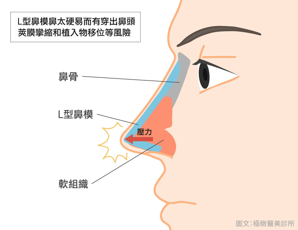隆鼻 鼻整形手術 你一定要知道的5件事