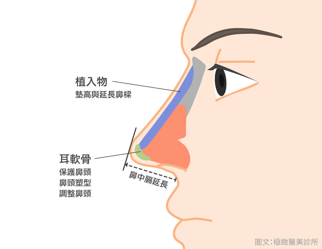 隆鼻 鼻整形手術 你一定要知道的5件事 隆鼻 鼻整形手術 你一定要知道的5件事