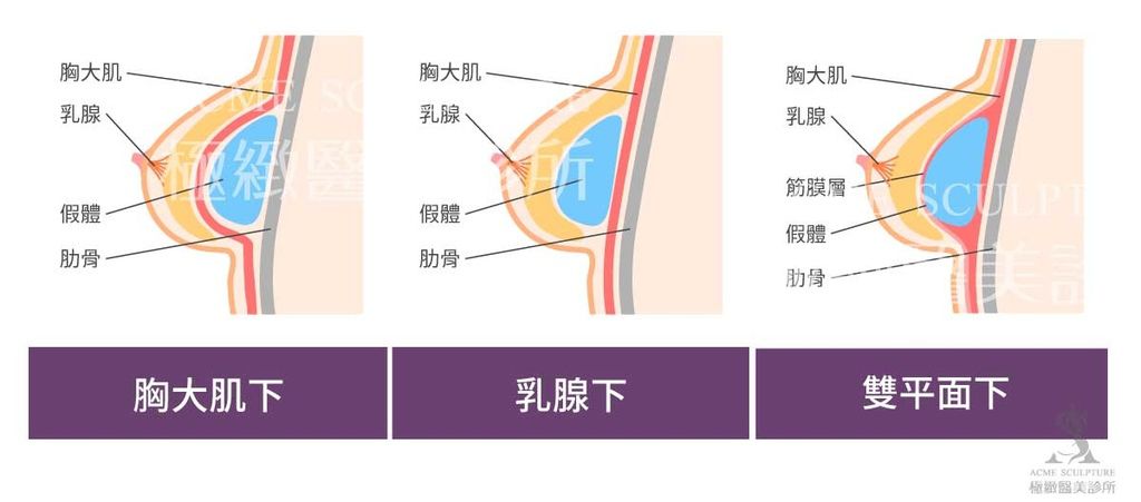 隆乳手術魔滴隆乳價錢極緻隆乳案例費用隆乳失敗自體脂肪隆乳果凍矽膠隆乳好嗎魔滴案例魔滴隆乳dcard (9).jpg