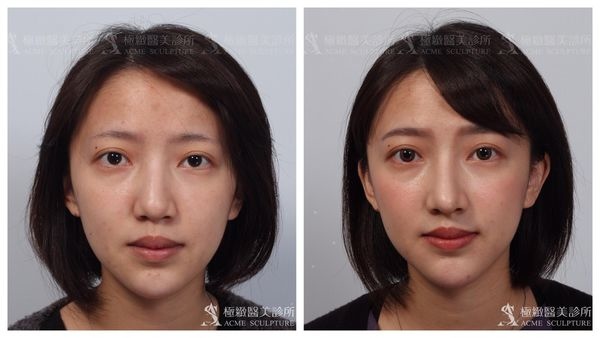 重修鼻手術 隆鼻失敗怎麼辦 還有辦法補救嗎 Acme Sculpture 極緻美人 痞客邦 重修鼻手術 隆鼻失敗怎麼辦 還有辦法補救嗎 Acme Sculpture 極緻美人 痞客邦