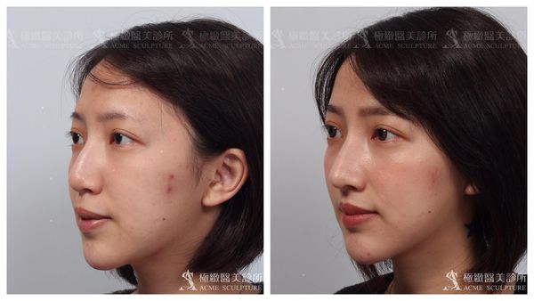 重修鼻手術 隆鼻失敗怎麼辦 還有辦法補救嗎 Acme Sculpture 極緻美人 痞客邦