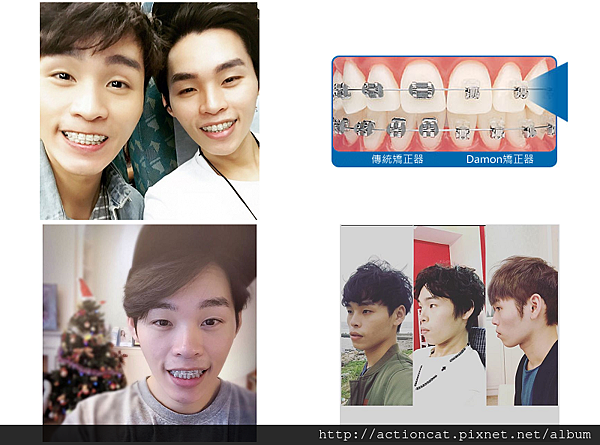 【牙套】矯正器諮詢注意事項(太平新光牙醫)