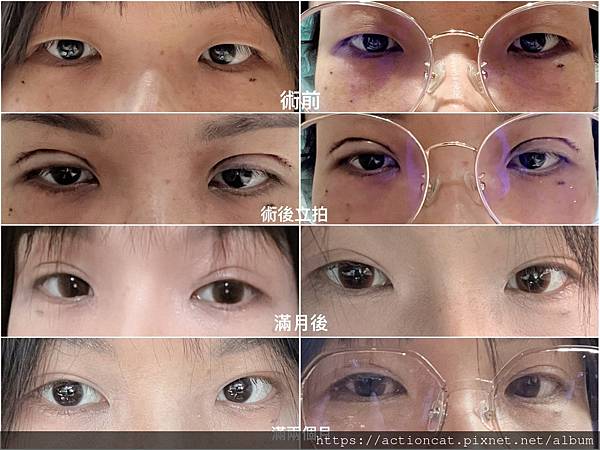 教科書級別教程~割雙眼皮實錄@嬌點美學診所 教科書級別教程~割雙眼皮實錄@嬌點美學診所